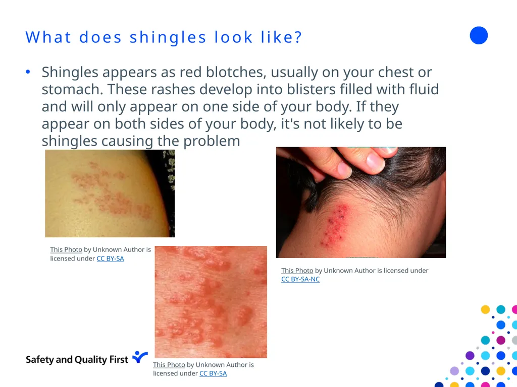 Shingles June 2022 Clair Stokes Infection - slide 9 of 24