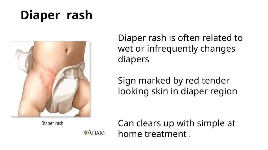Common dermatological disorders in pediatrics - slide 29 of 35