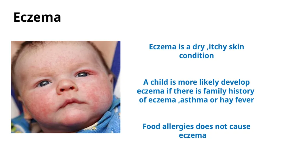 Common dermatological disorders in pediatrics - slide 22 of 35