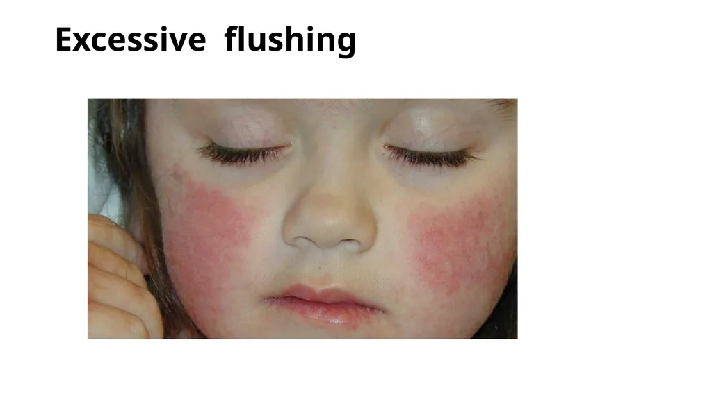 Common dermatological disorders in pediatrics - slide 17 of 35