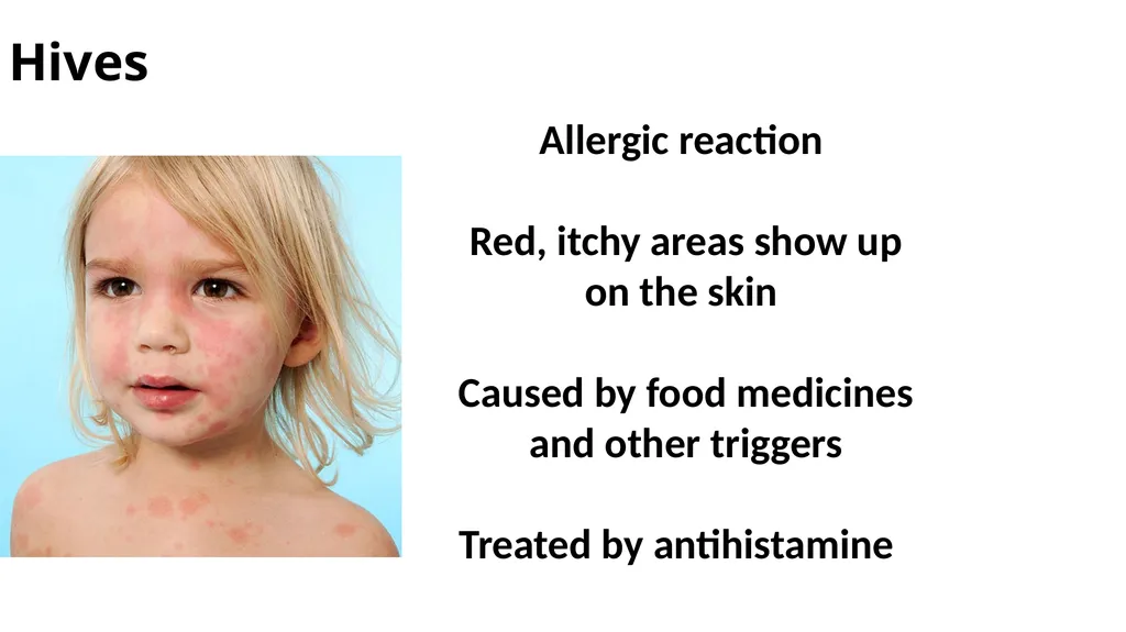 Common dermatological disorders in pediatrics - slide 27 of 35