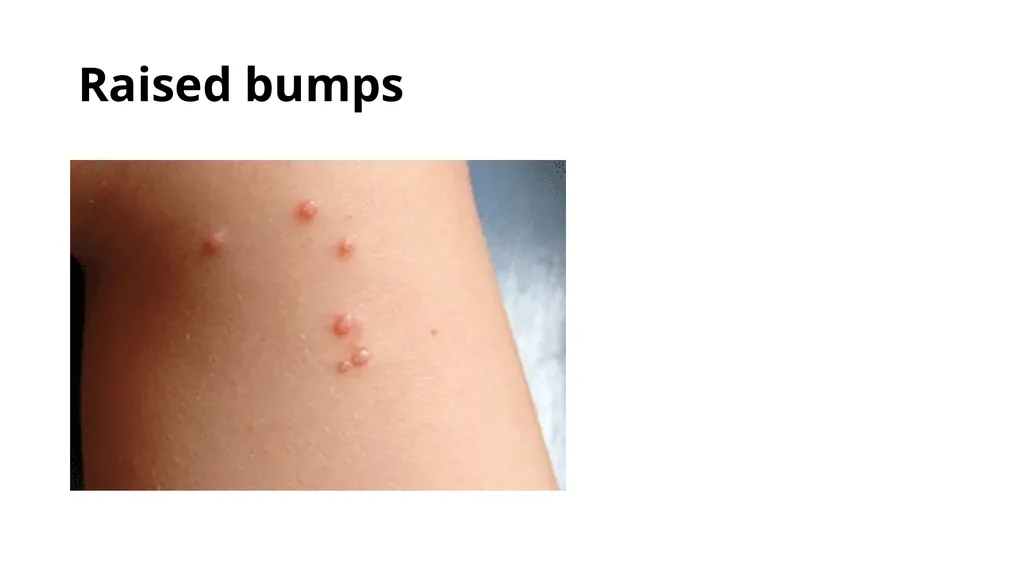Common dermatological disorders in pediatrics - slide 9 of 35