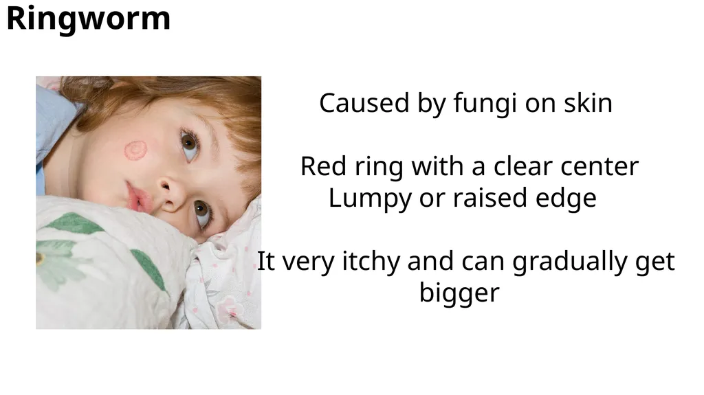 Common dermatological disorders in pediatrics - slide 28 of 35