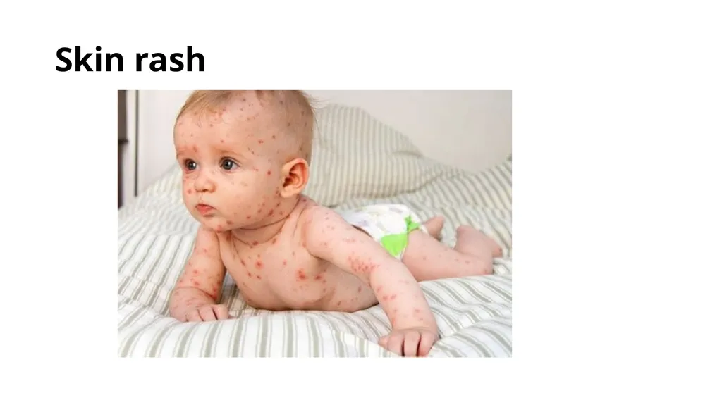 Common dermatological disorders in pediatrics - slide 8 of 35