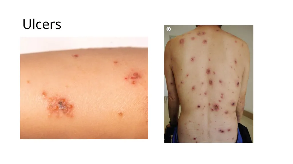 Common dermatological disorders in pediatrics - slide 12 of 35