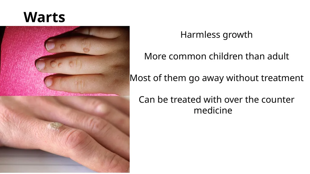 Common dermatological disorders in pediatrics - slide 25 of 35