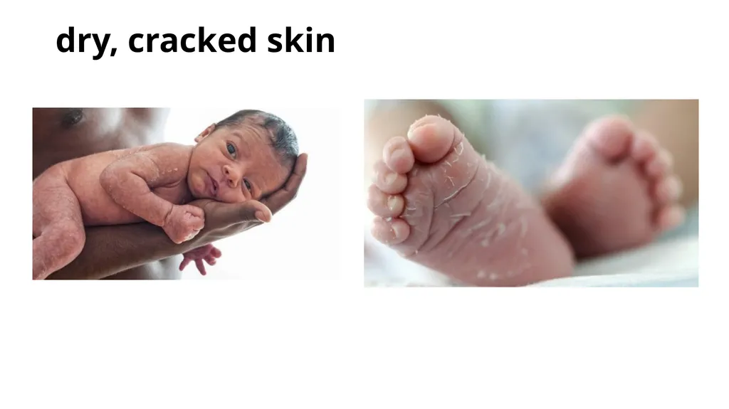 Common dermatological disorders in pediatrics - slide 13 of 35