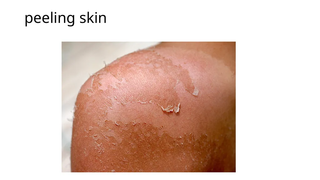 Common dermatological disorders in pediatrics - slide 11 of 35