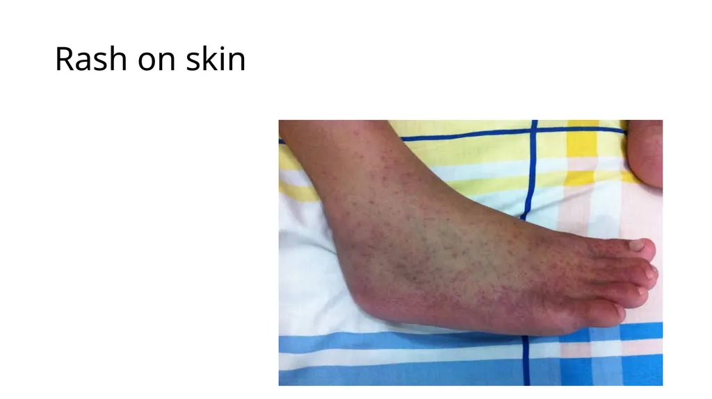 Chikungunya aedes mosquito Alpha virus Rash on - slide 3 of 8