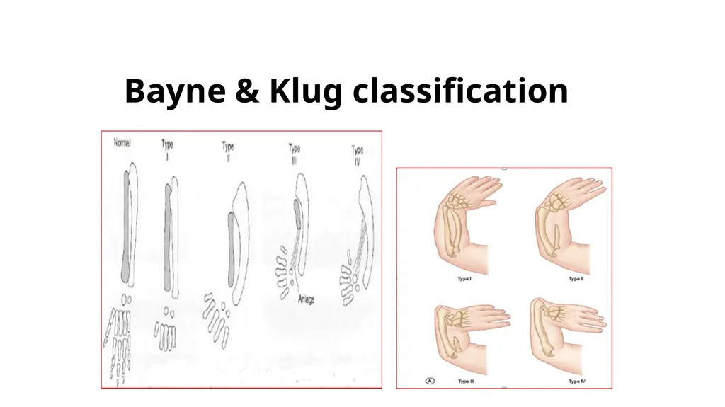 Congenital Hand Abnormalities Nick Sheppard AO AF - slide 11 of 26