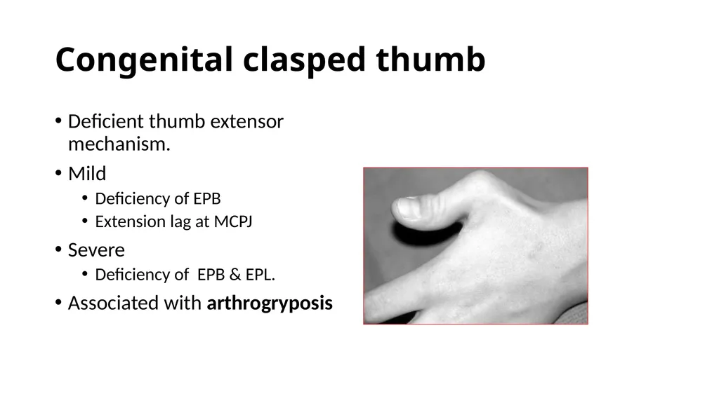 Congenital Hand Abnormalities Nick Sheppard AO AF - slide 5 of 26