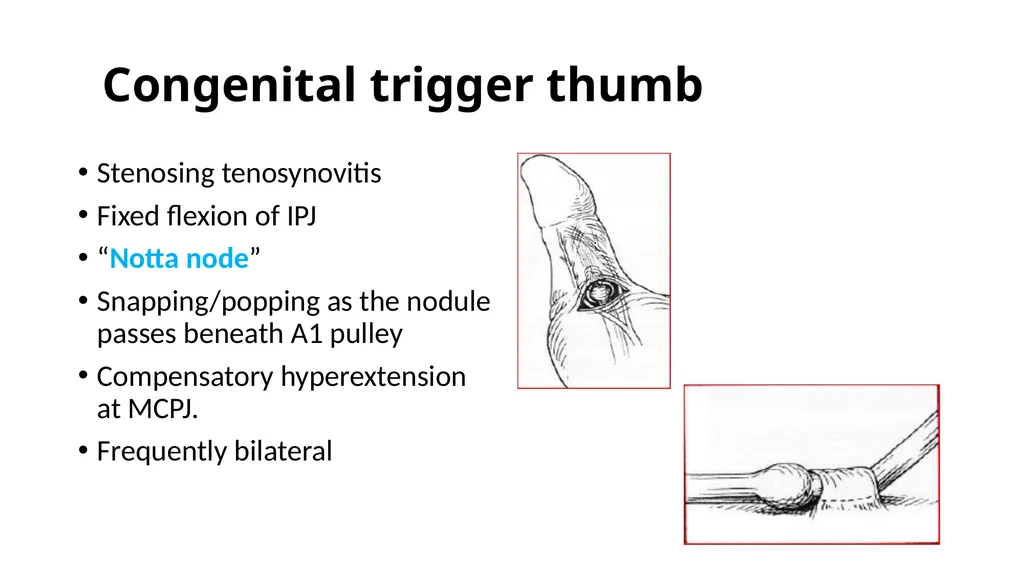 Congenital Hand Abnormalities Nick Sheppard AO AF - slide 4 of 26