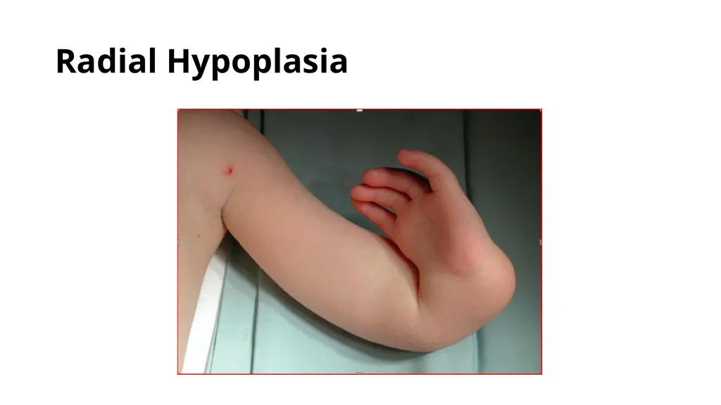 Congenital Hand Abnormalities Nick Sheppard AO AF - slide 10 of 26