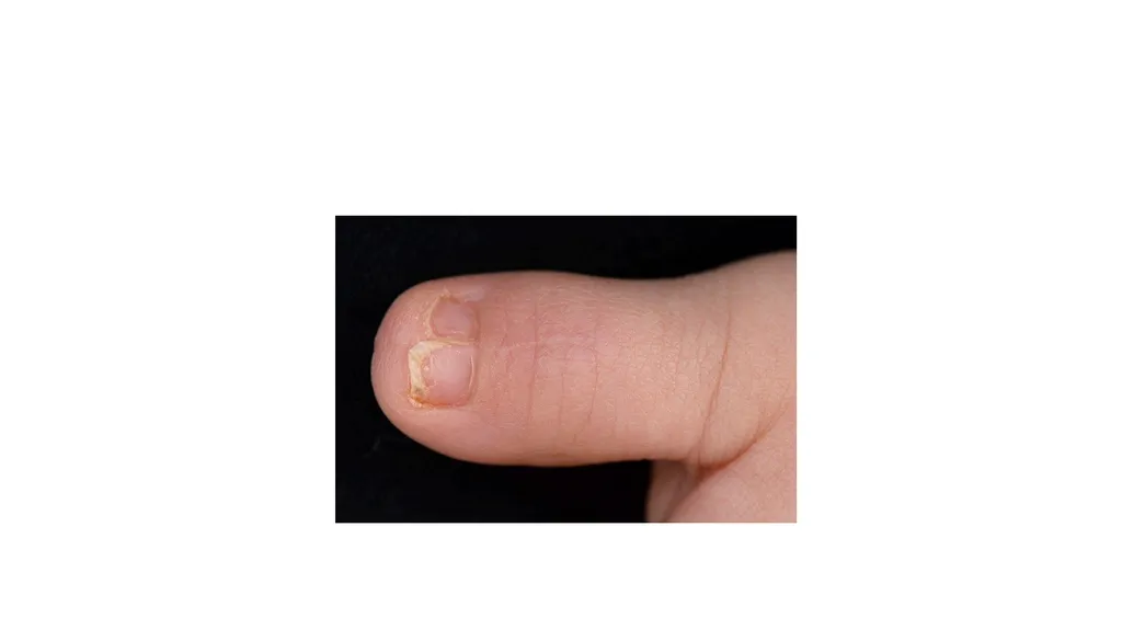 Congenital Hand Abnormalities Nick Sheppard AO AF - slide 15 of 26