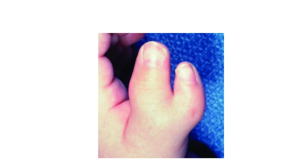 Congenital Hand Abnormalities Nick Sheppard AO AF - slide 16 of 26