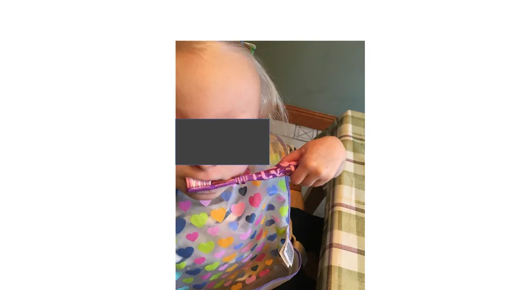 Congenital Hand Abnormalities Nick Sheppard AO AF - slide 22 of 26