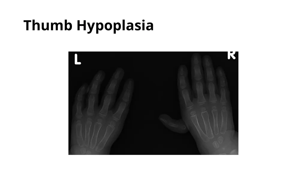 Congenital Hand Abnormalities Nick Sheppard AO AF - slide 17 of 26