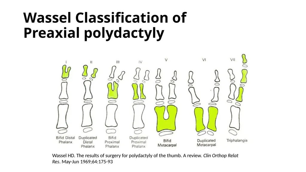 Congenital Hand Abnormalities Nick Sheppard AO AF - slide 14 of 26