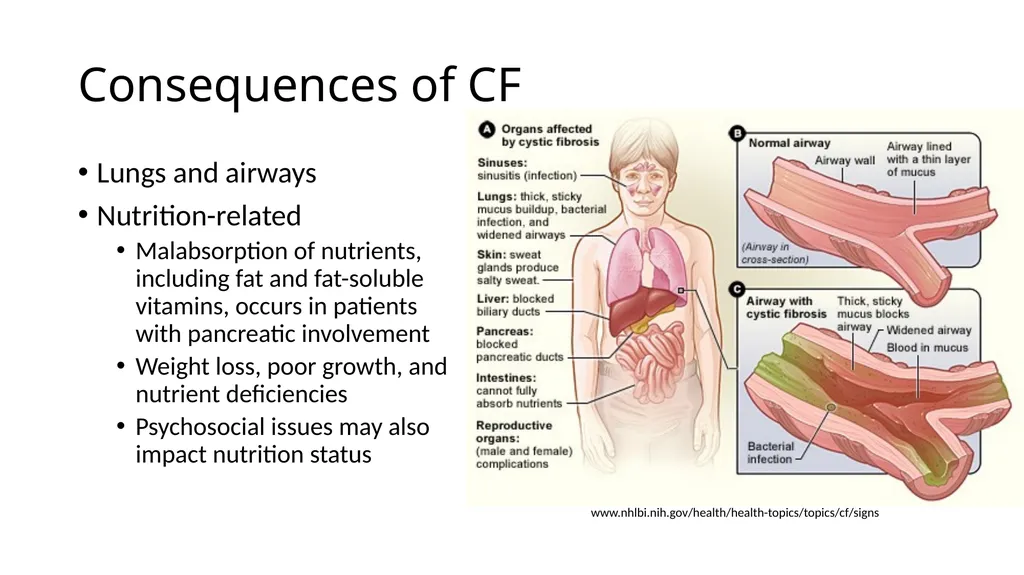 Nutrition and Cystic Fibrosis Module 1: Cystic - slide 6 of 20