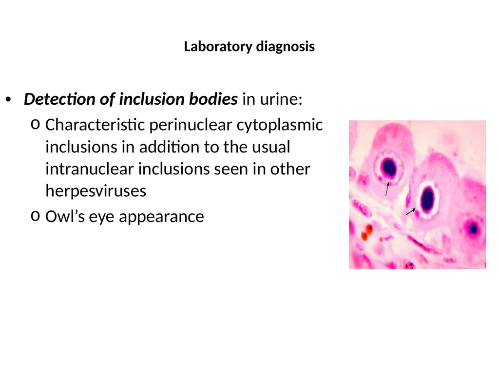 CYTOMEGALOVIRUS Largest virus in herpes viridae - slide 11 of 22