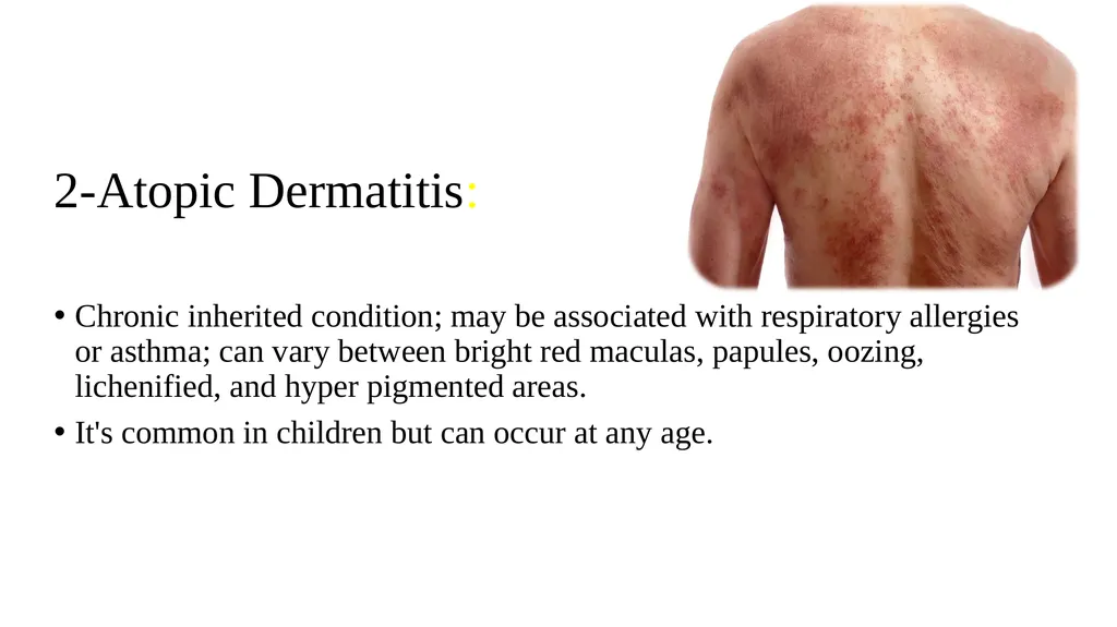 Skin disorder Dermatitis Assistant lecturers Sadiq - slide 6 of 17