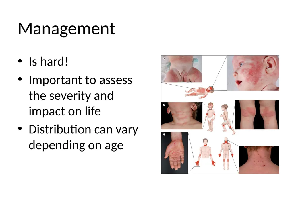 Atopic Eczema in children Dr C Macaulay Dr C Lemer - slide 4 of 15