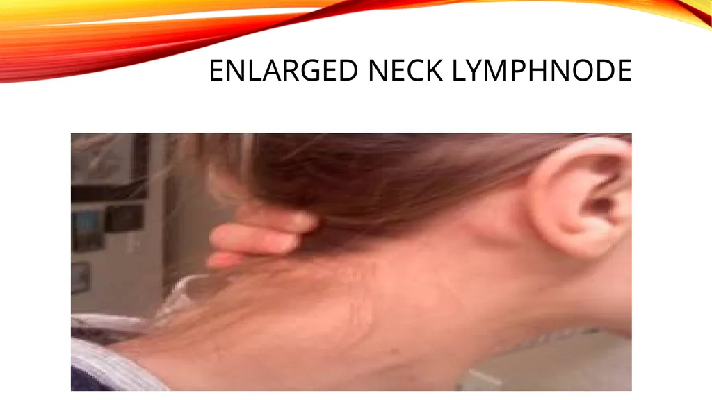 LYMPHOMA & LEUKEMIA a closer look SEER - slide 19 of 37