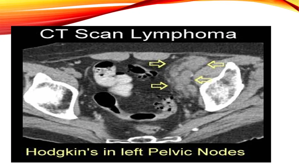 LYMPHOMA & LEUKEMIA a closer look SEER - slide 17 of 37