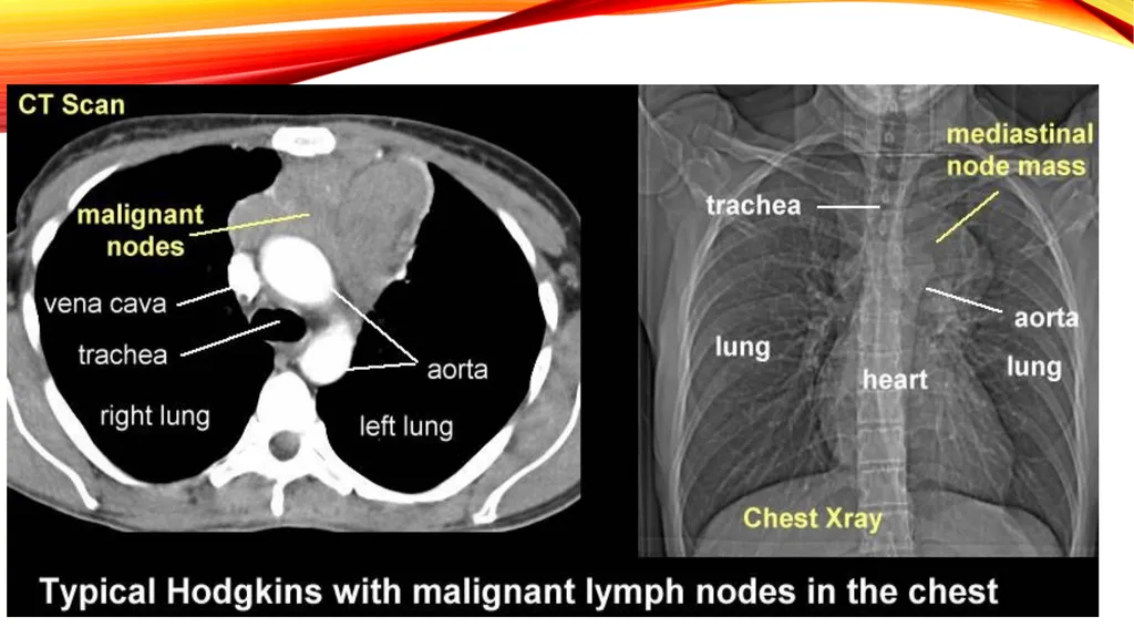 LYMPHOMA & LEUKEMIA a closer look SEER - slide 18 of 37