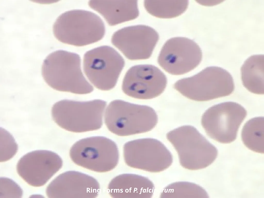 MALARIA By TARIK ZAHER Assistant Professor of - slide 8 of 46