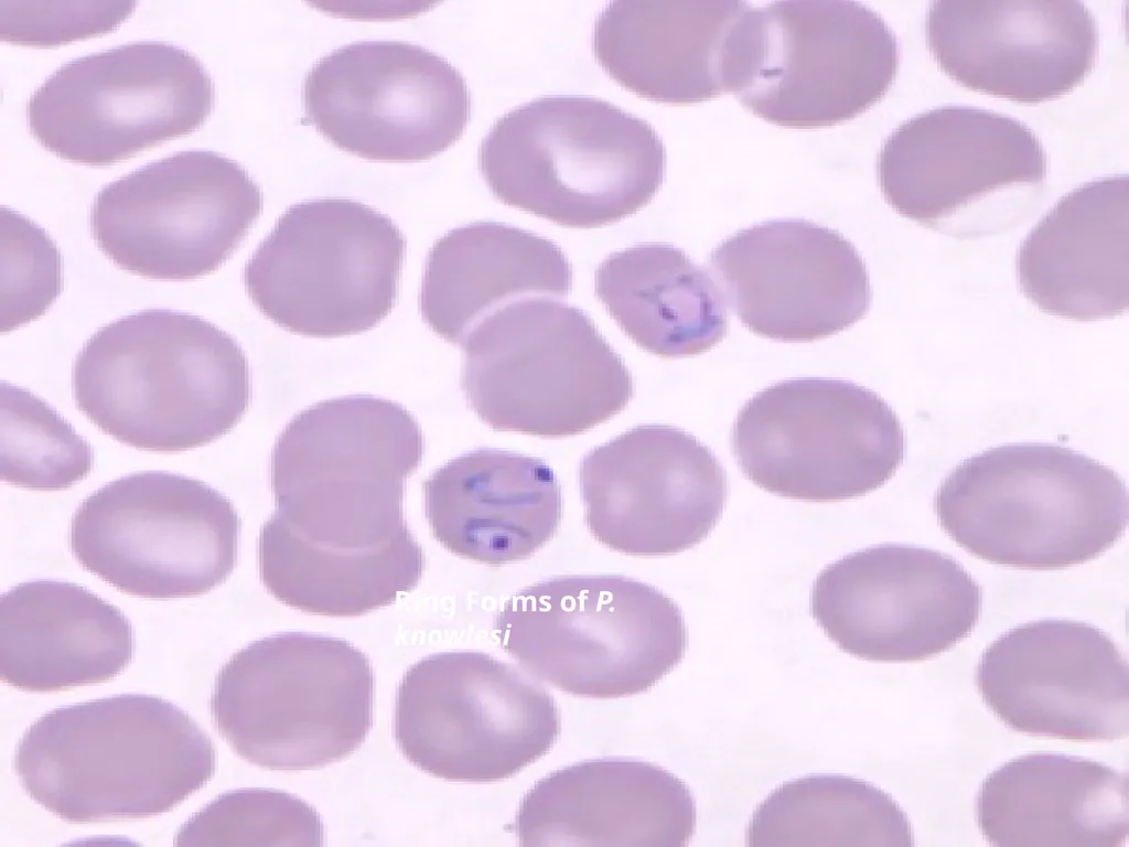 MALARIA By TARIK ZAHER Assistant Professor of - slide 12 of 46
