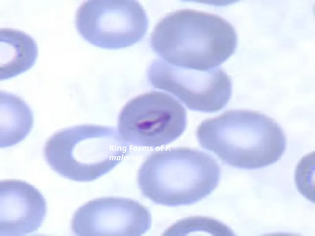 MALARIA By TARIK ZAHER Assistant Professor of - slide 11 of 46