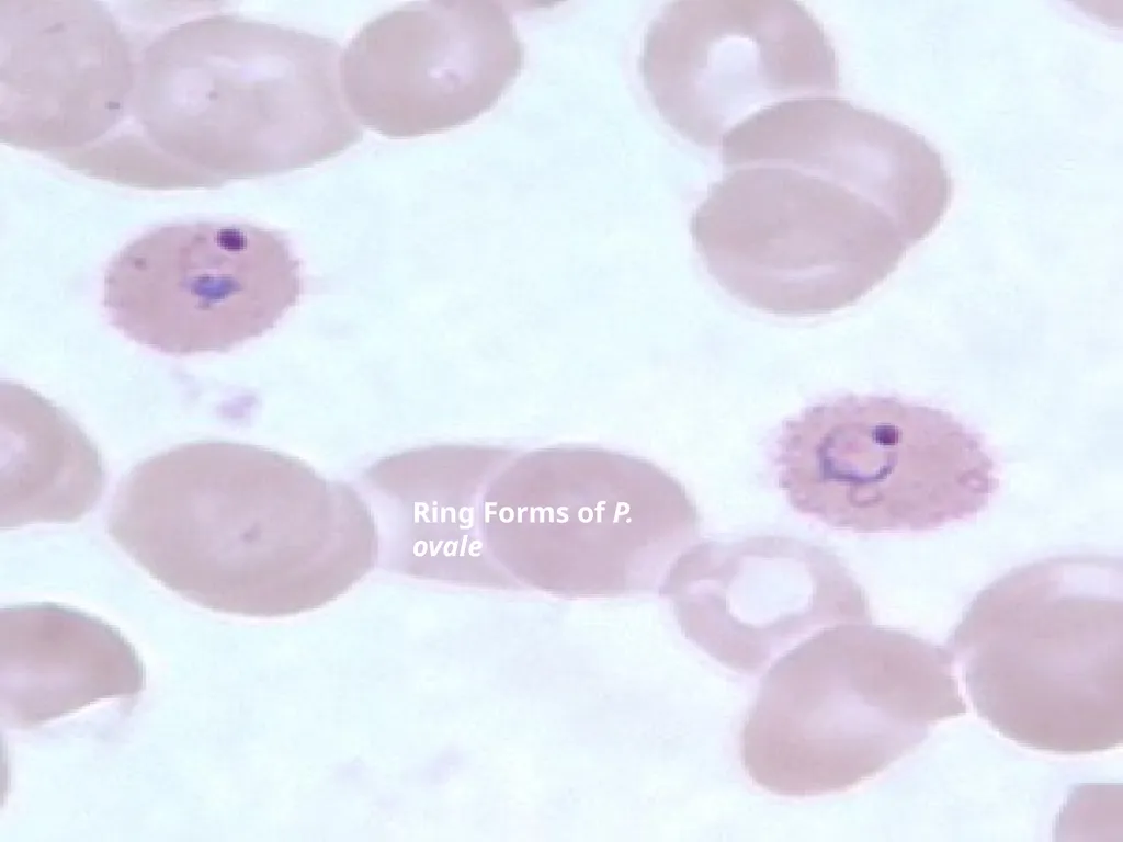 MALARIA By TARIK ZAHER Assistant Professor of - slide 10 of 46