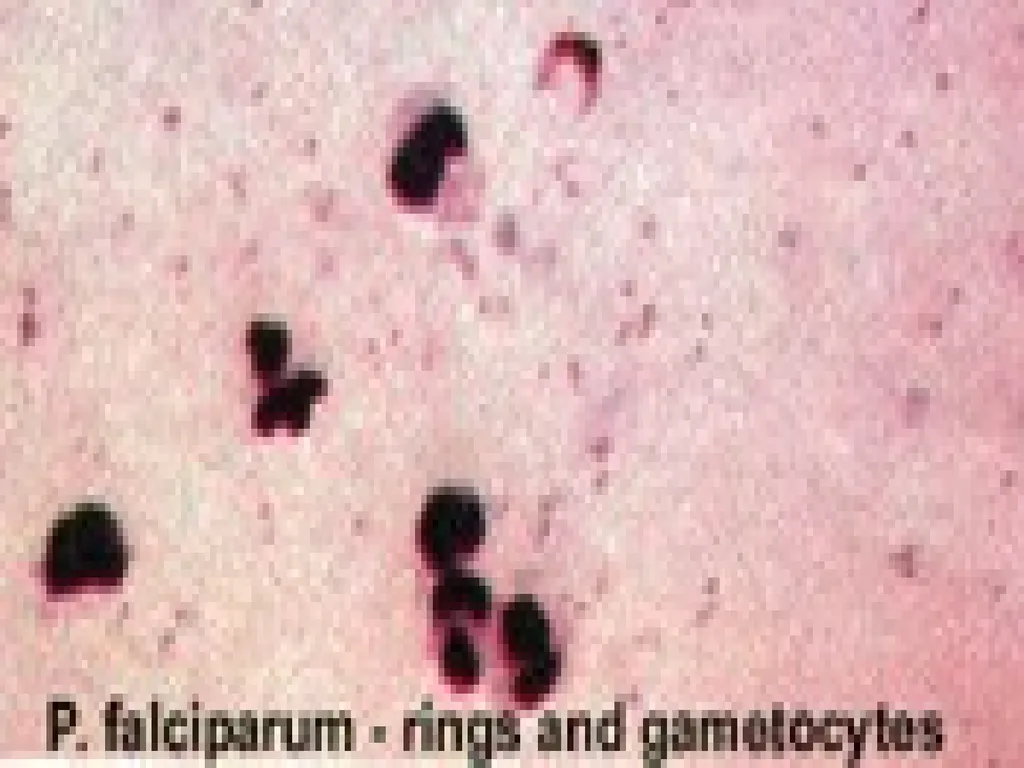 MALARIA By TARIK ZAHER Assistant Professor of - slide 30 of 46