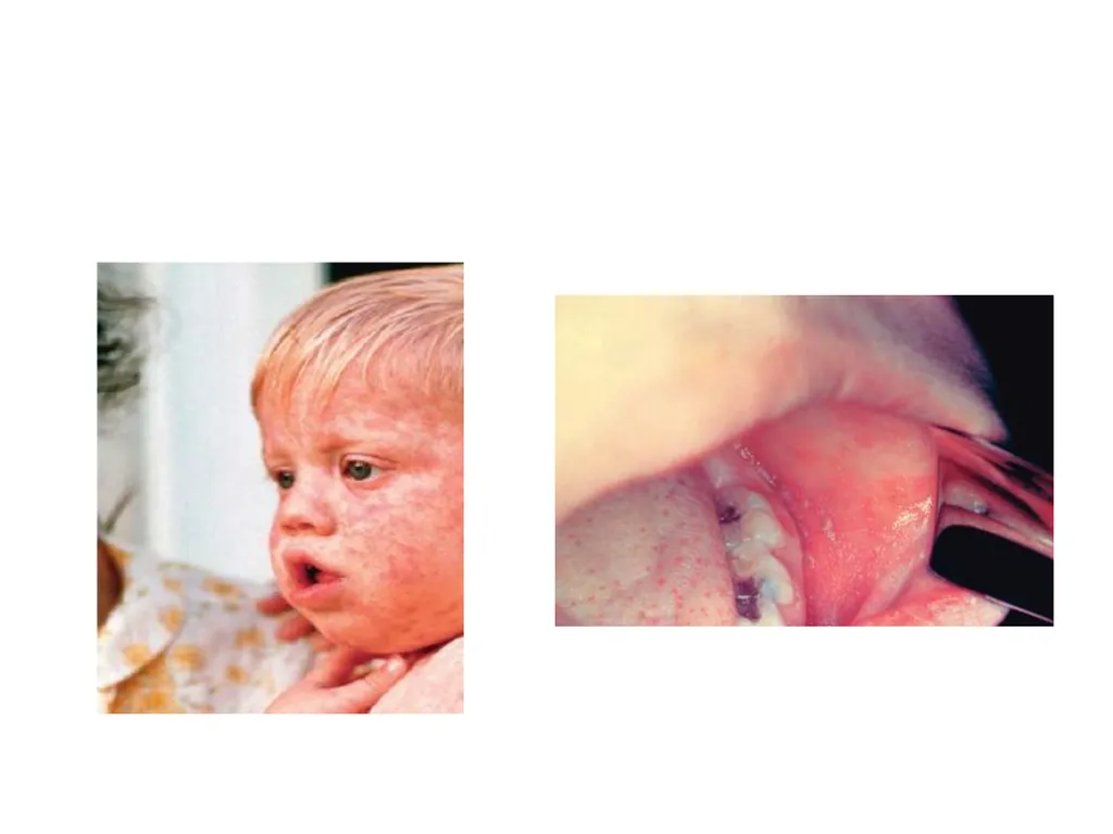 MEASLES DR JAYAPRAKASH.K.P ASSO. PROF.PEDIATRICS - slide 8 of 20