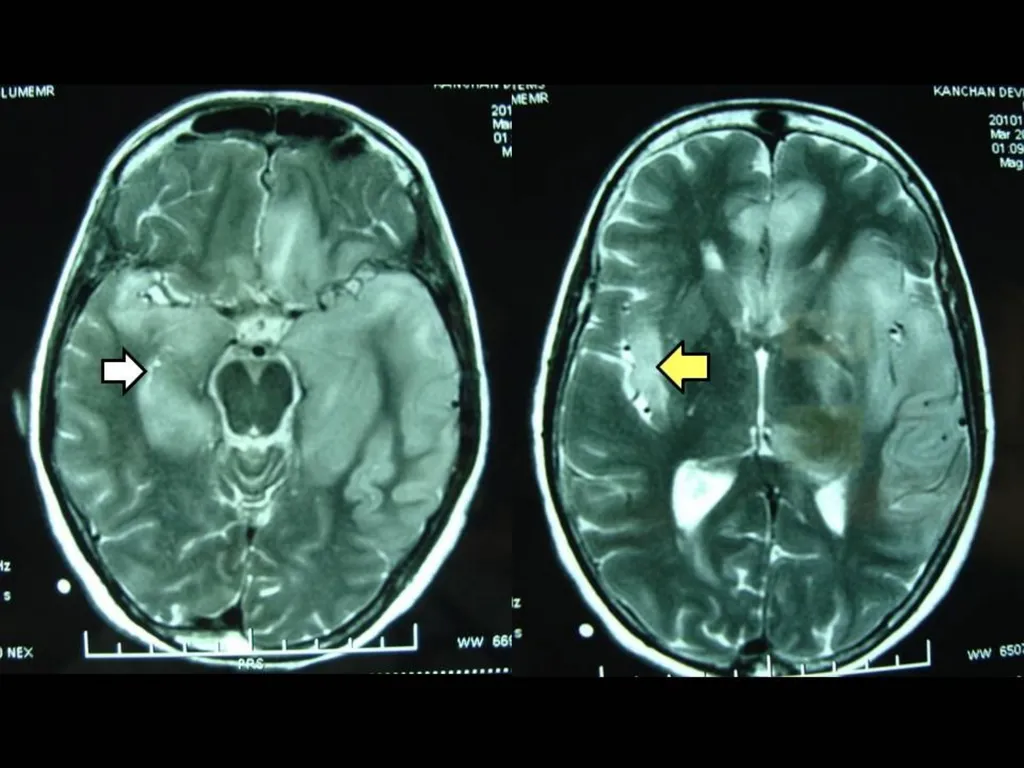 Acute Bacterial Meningitis Bacterial meningitis is - slide 33 of 50