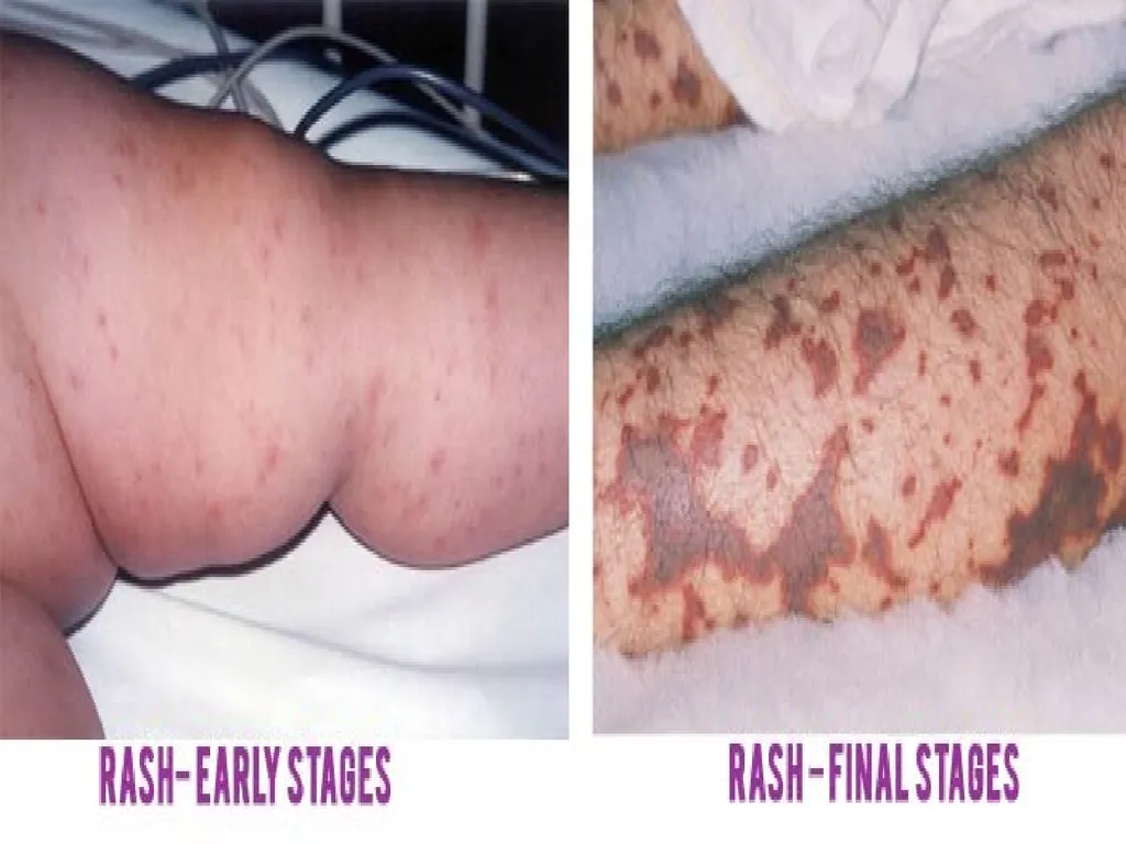 Acute Bacterial Meningitis Bacterial meningitis is - slide 7 of 50