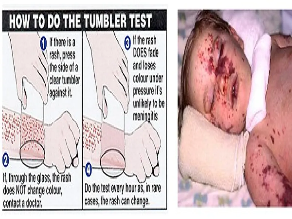 Acute Bacterial Meningitis Bacterial meningitis is - slide 8 of 50