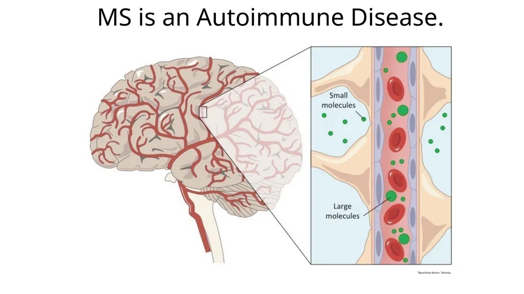 Multiple Sclerosis Kiera Borthwick “What does MS - slide 5 of 12