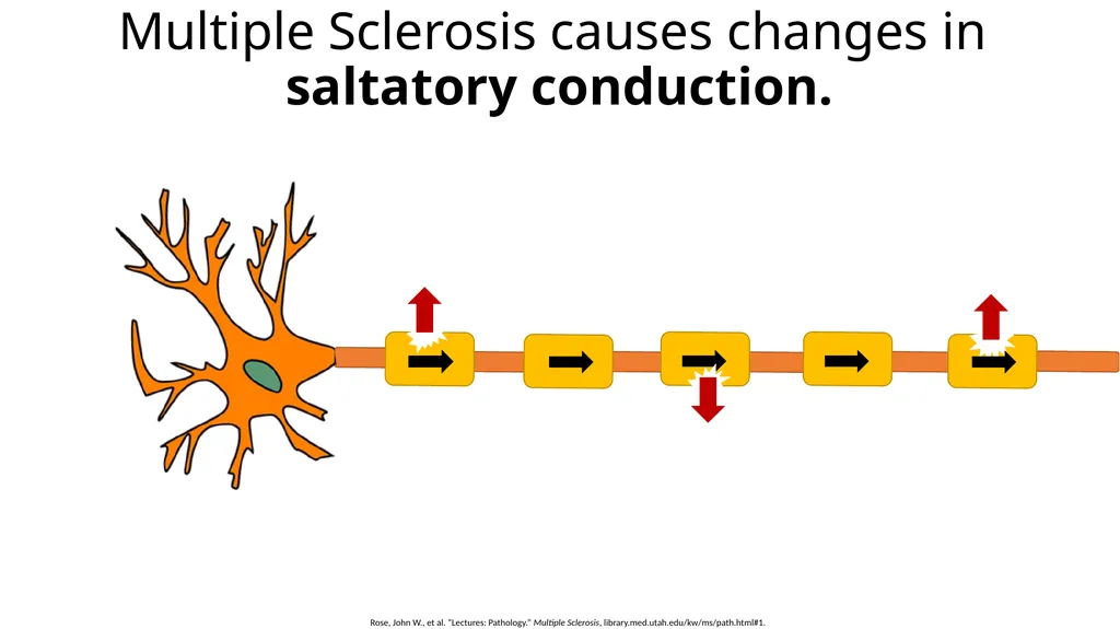 Multiple Sclerosis Kiera Borthwick “What does MS - slide 7 of 12
