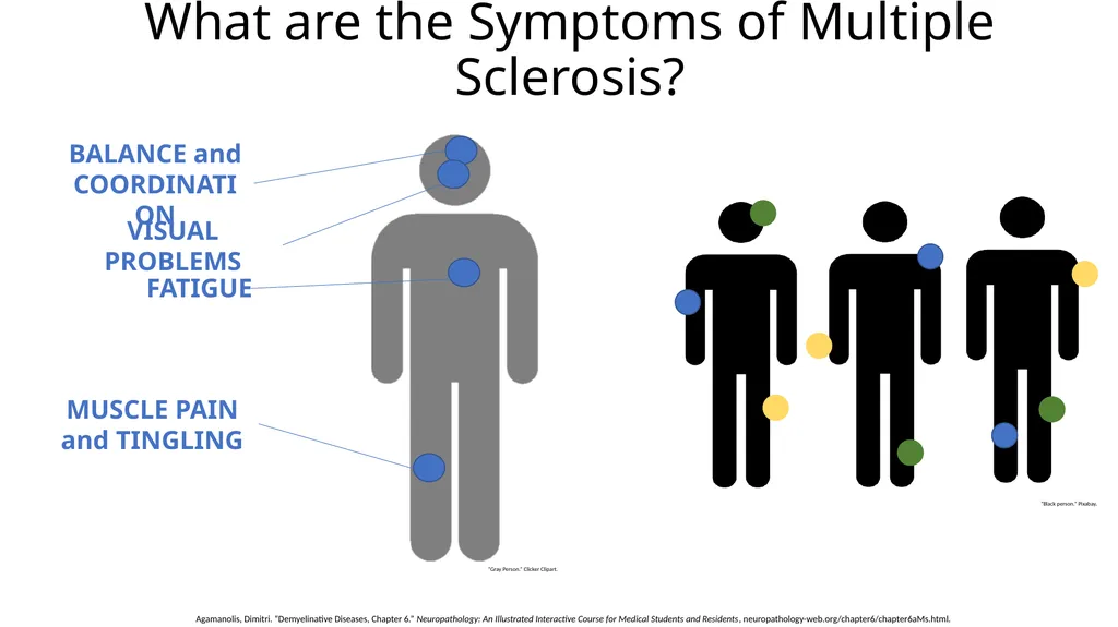 Multiple Sclerosis Kiera Borthwick “What does MS - slide 8 of 12