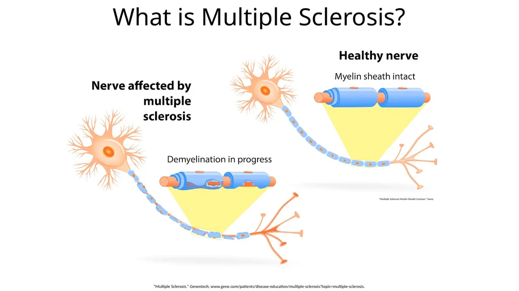 Multiple Sclerosis Kiera Borthwick “What does MS - slide 4 of 12