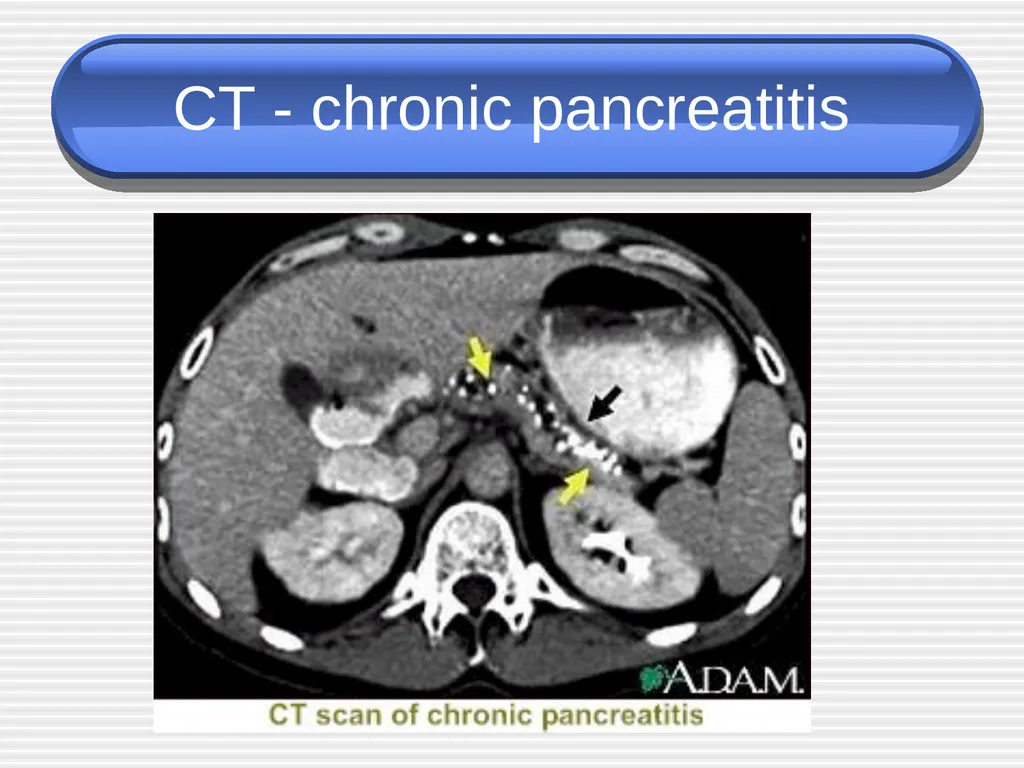 Acute pancreatitis defined as an acute condition - slide 31 of 36