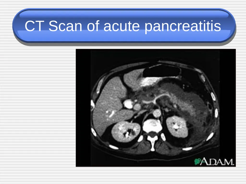 Acute pancreatitis defined as an acute condition - slide 12 of 36