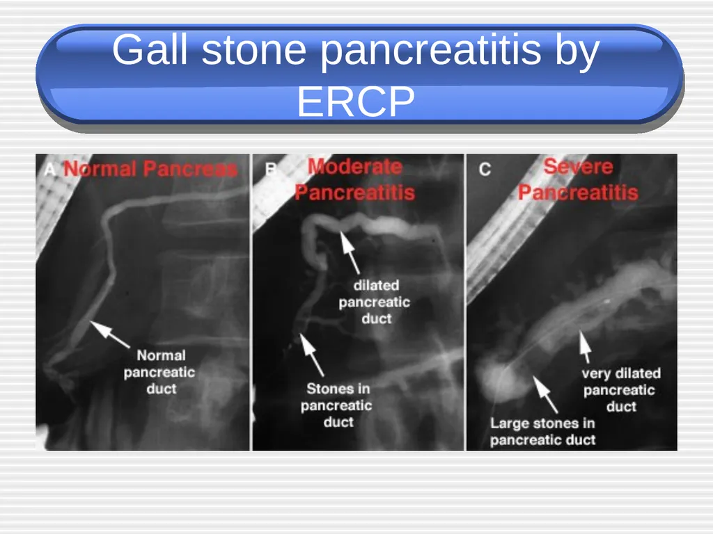 Acute pancreatitis defined as an acute condition - slide 13 of 36