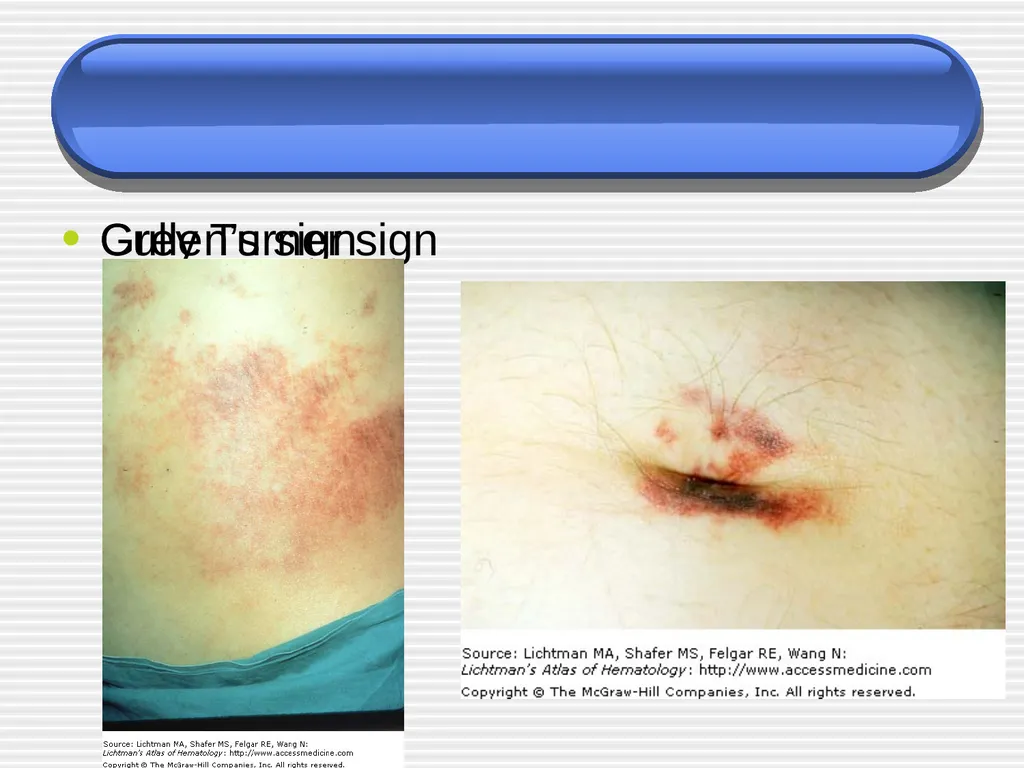 Acute pancreatitis defined as an acute condition - slide 7 of 36