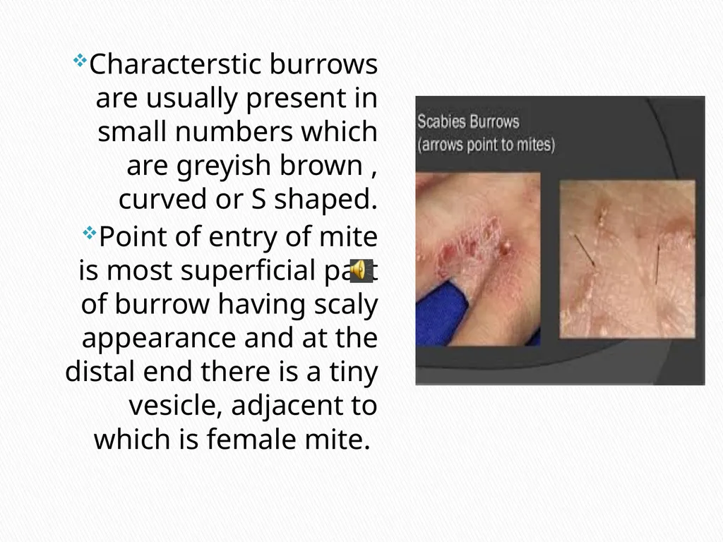 SCABIES Dr. KRITIKA JOSHI Assistant professor - slide 4 of 6