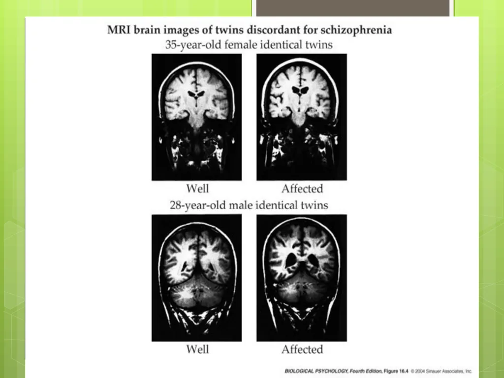 SCHIZOPHRENIA Presenter: Dr. Arpit Jaiswal - slide 21 of 46