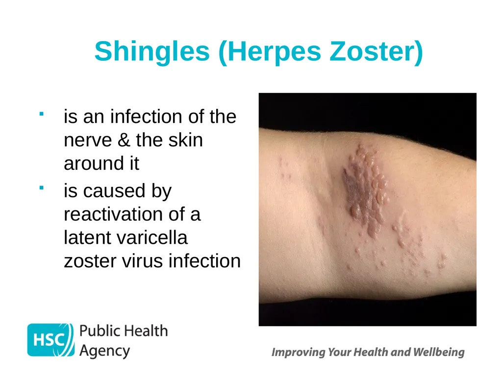Shingles (Herpes Zoster) September 2023 Shingles - slide 2 of 39
