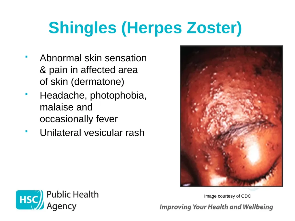 Shingles (Herpes Zoster) September 2023 Shingles - slide 3 of 39